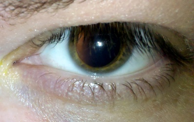 Dilated eye