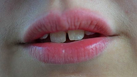 Lips and teeth